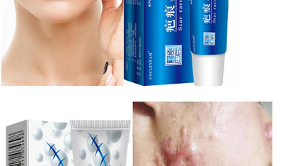 Acne Scar Removal Cream