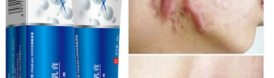 Acne Scar Removal Cream