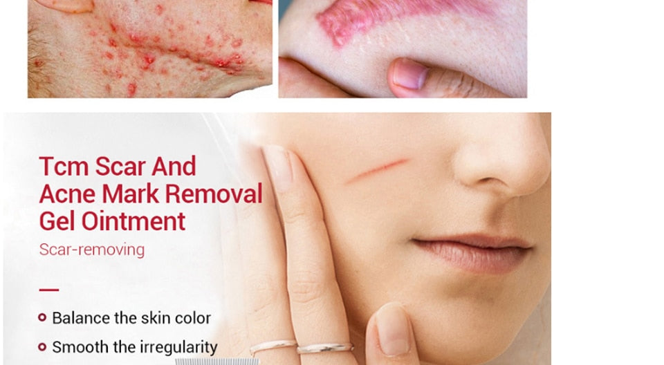 Acne Scar Removal Cream